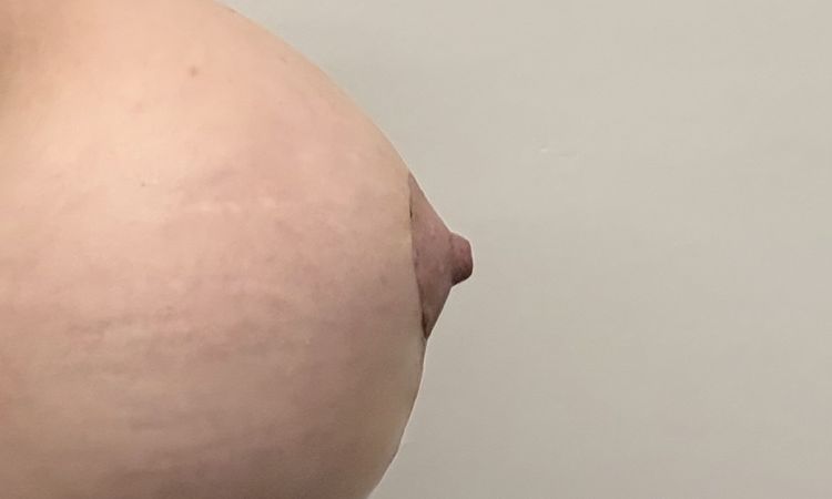 Seno con profilo irregolare dopo Mastopessi e mastoplastica additiva - 83563