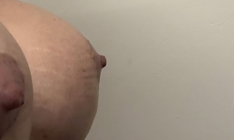 Seno con profilo irregolare dopo Mastopessi e mastoplastica additiva - 83564