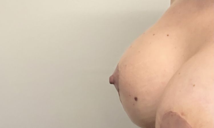 Seno con profilo irregolare dopo Mastopessi e mastoplastica additiva - 83565