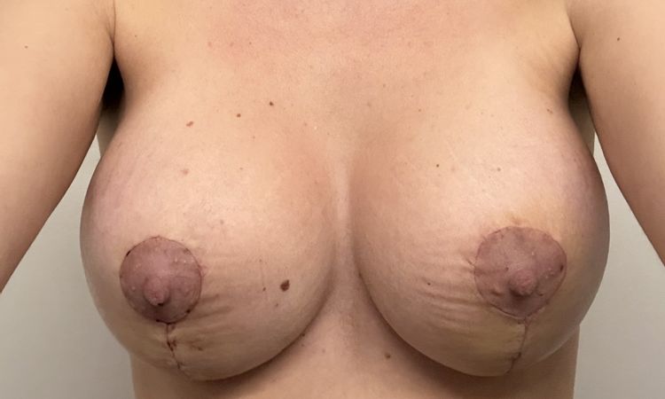 Seno con profilo irregolare dopo Mastopessi e mastoplastica additiva - 83566