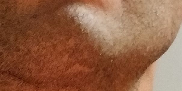 Salve cicatrice mento procurata 6 anni fa - 83576