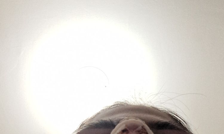 2 giorni post rinoplastica - 83636