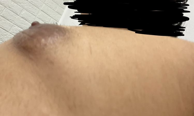 Capezzolo gonfio dopo un anno e mezzo ginecomastia - 83668