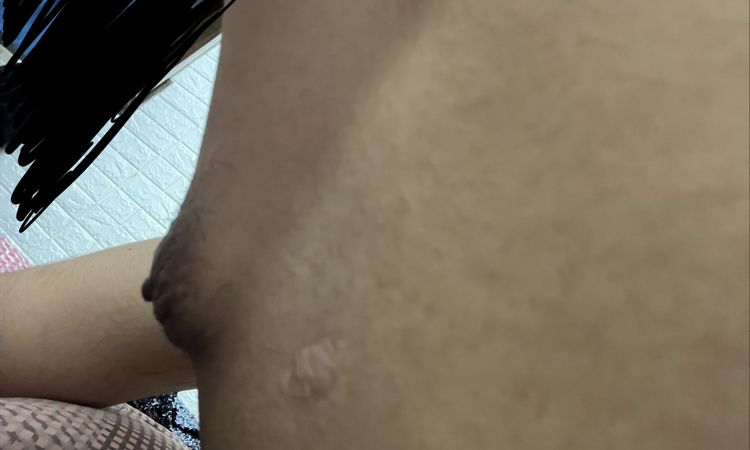 Capezzolo gonfio dopo un anno e mezzo ginecomastia - 83670