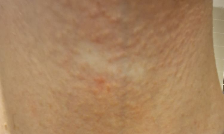 Ipopigmentazione da ustione Luce Pulsata sul collo dopo 3 anni - 83725