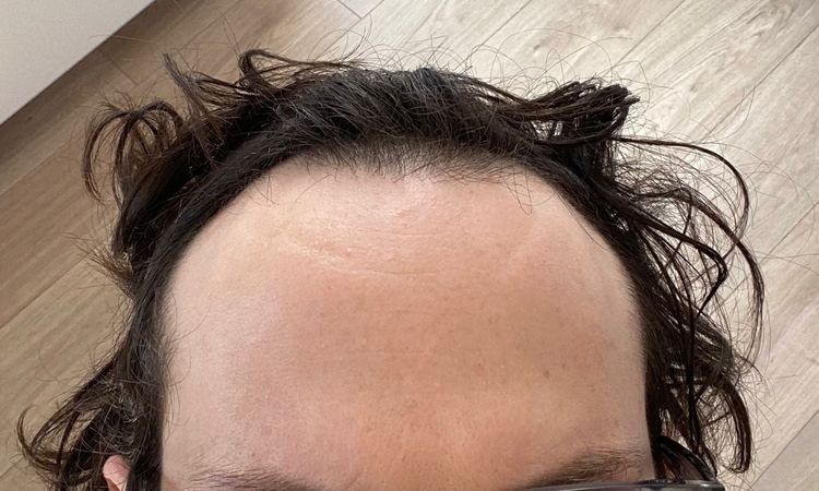 Profondo solco sulla fronte - 83751