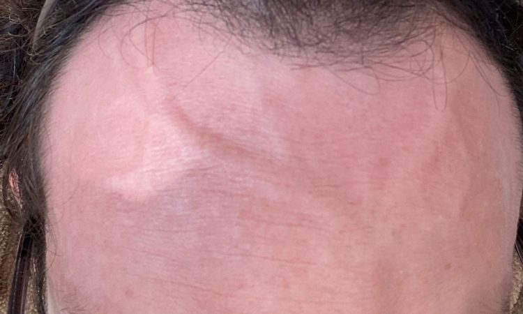 Profondo solco sulla fronte - 83752