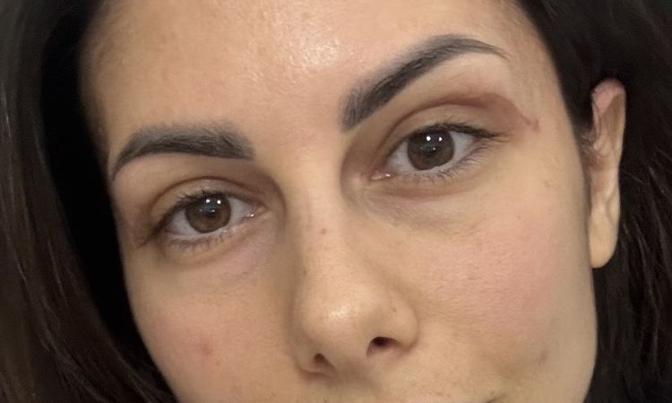 Cicatrice troppo altaBlefaroplastica superiore - 83753