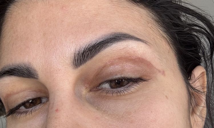 Cicatrice troppo altaBlefaroplastica superiore - 83754