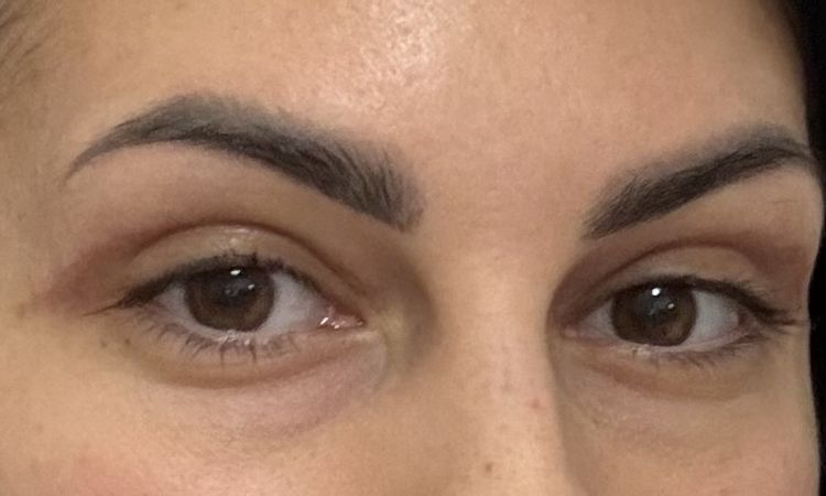 Cicatrice troppo altaBlefaroplastica superiore - 83755