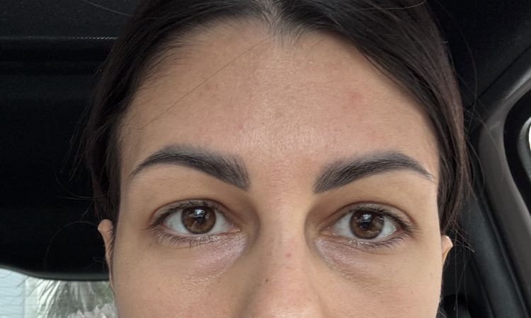 Cicatrice troppo altaBlefaroplastica superiore - 83756