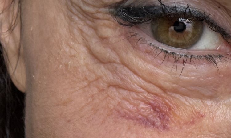 Pellaccia post blefaro inferiore - 83812