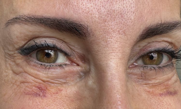 Pellaccia post blefaro inferiore - 83813