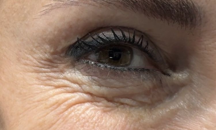 Pellaccia post blefaro inferiore - 83814