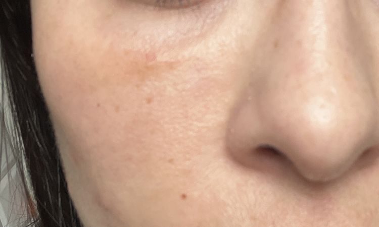 Ialuronidasi borse occhi a 5 giorni - 83829