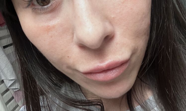 Ialuronidasi borse occhi a 5 giorni - 83830