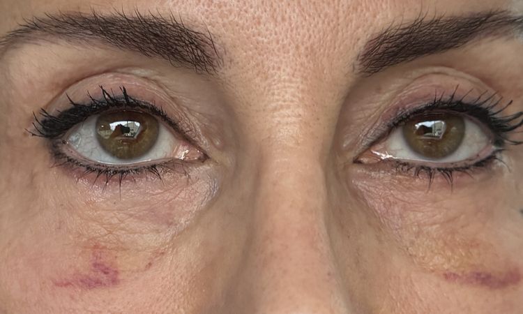 Blefaro inferiore e abbassamento palpebra - 83843