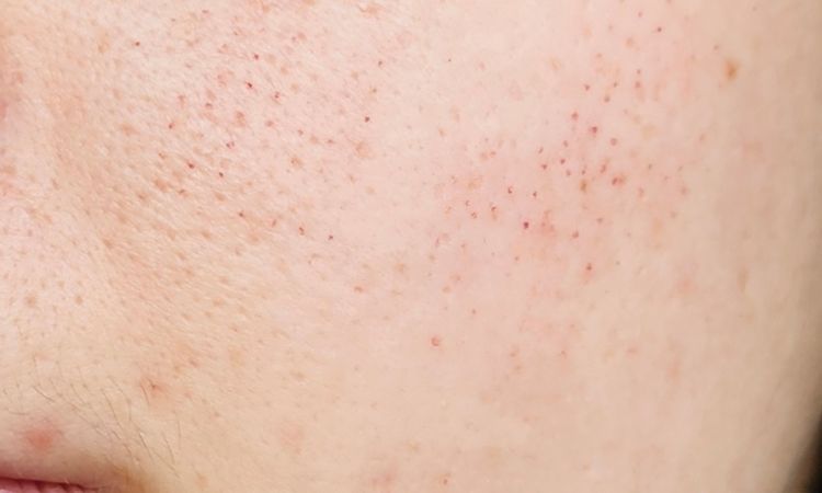 Segni post radiofrequenza frazionata - 83880