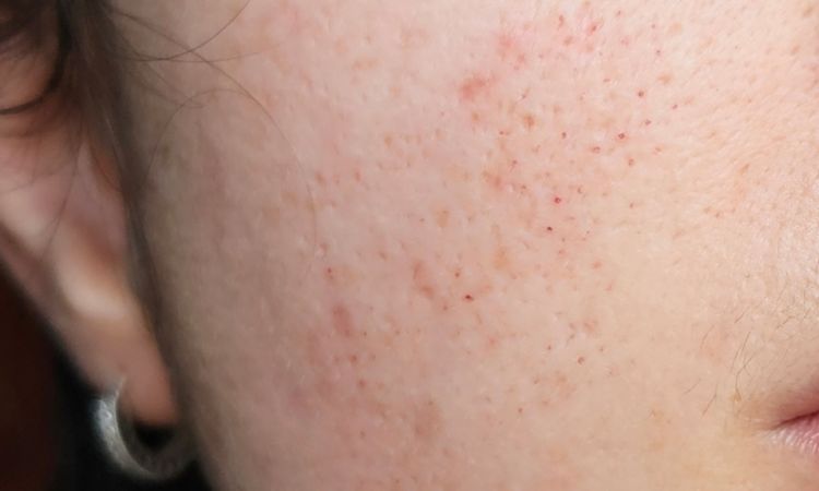 Segni post radiofrequenza frazionata - 83881