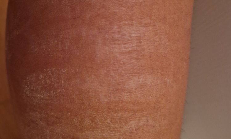 Ustioni dopo 3 mesi dalla depilazione laser. - 83907