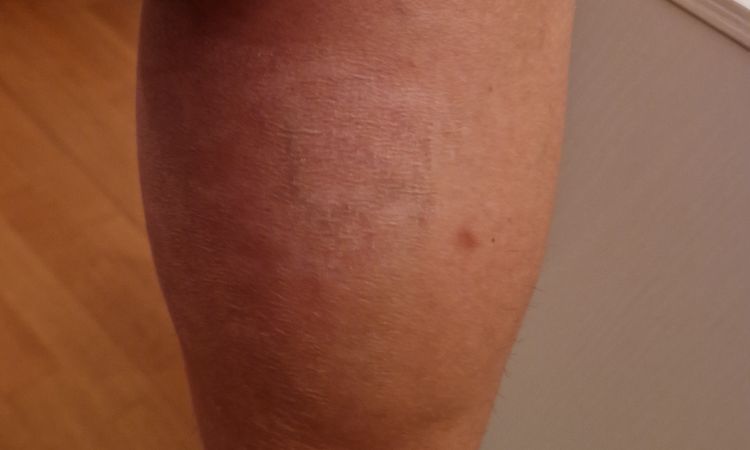 Ustioni dopo 3 mesi dalla depilazione laser. - 83908