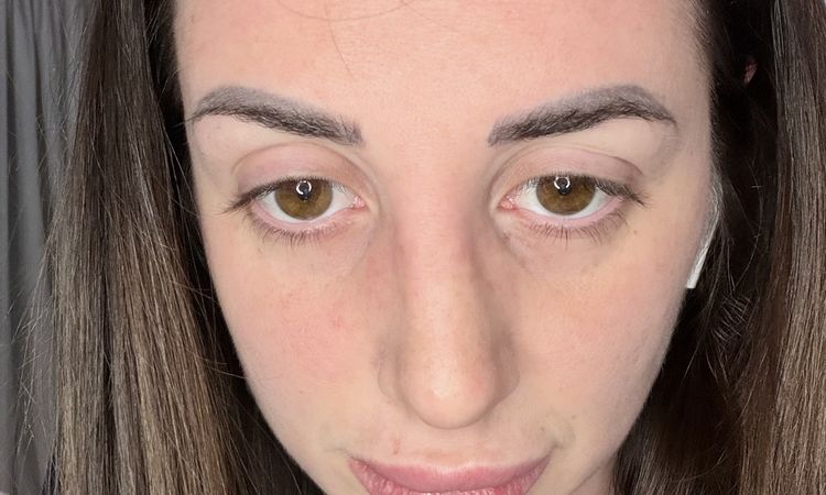 dubbi sulla deviazione ancora presente e sul dorso ancora largo - 83909