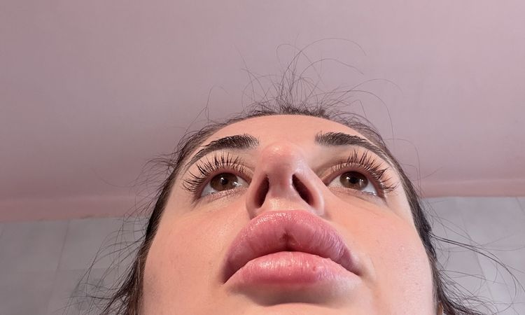 dubbi sulla deviazione ancora presente e sul dorso ancora largo - 83910