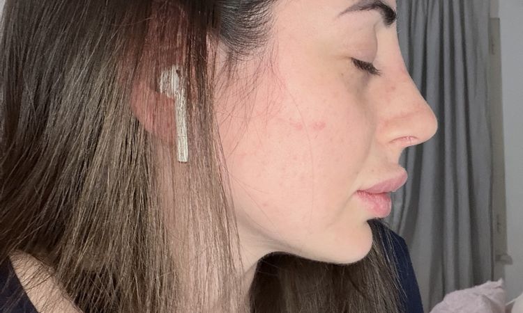 dubbi sulla deviazione ancora presente e sul dorso ancora largo - 83911