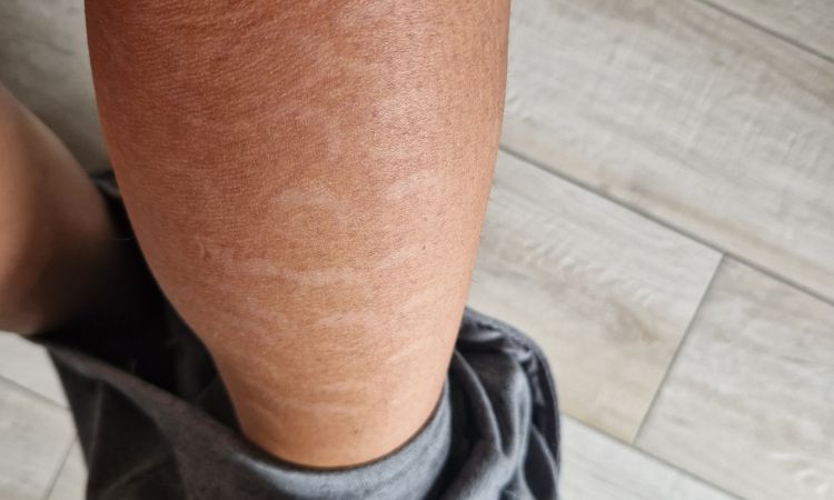 da 3 mesi ho queste macchie bianche. Se ne andranno? - 83919