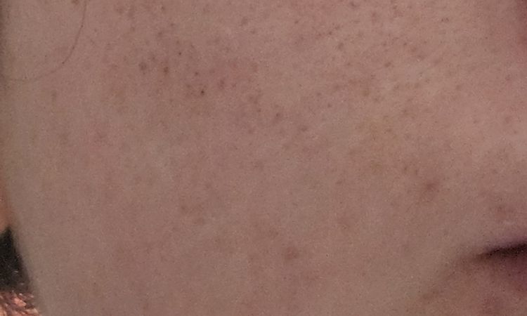 Segni post radiofrequenza frazionata ad aghi - 83920