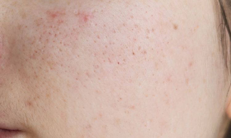 Segni post radiofrequenza frazionata ad aghi - 83921