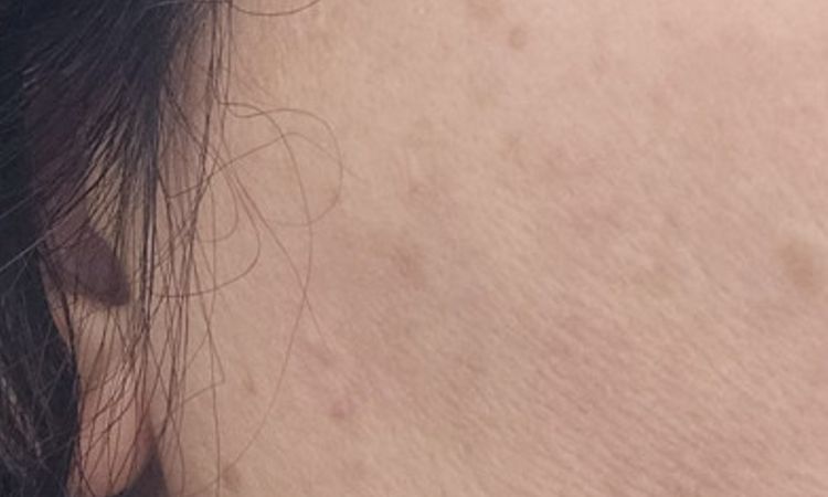 Acantosi nigricans o melasma? - 83926