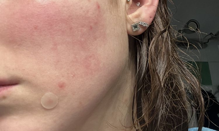 Reticolo post laser co2 dopo due mesi - 83935