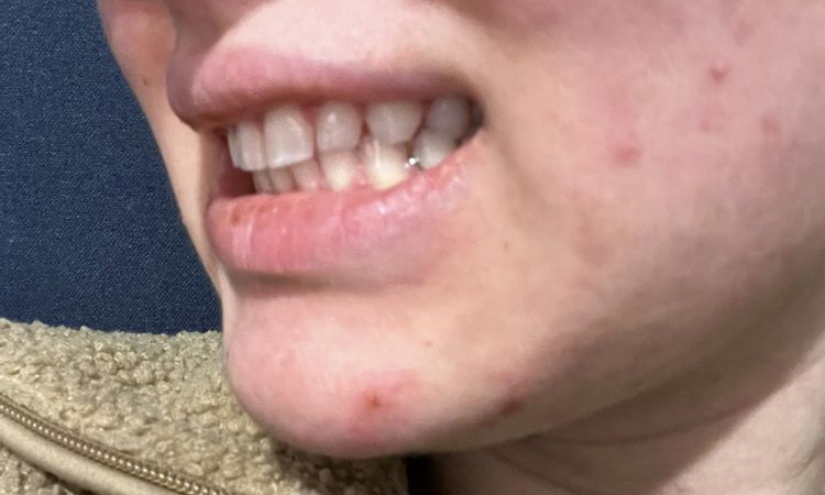 Malocclusione di tipo II - 83942