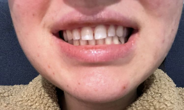 Malocclusione di tipo II - 83943