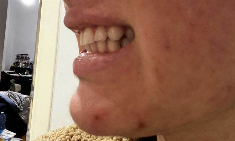 Malocclusione di tipo II - 83944