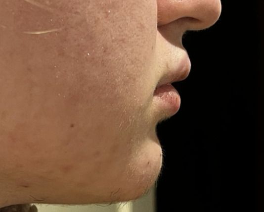 Malocclusione di tipo II - 83945