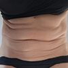 Renuvion su addome dopo liposuzione