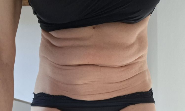 Renuvion su addome dopo liposuzione - 84000