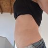 Renuvion su addome dopo liposuzione