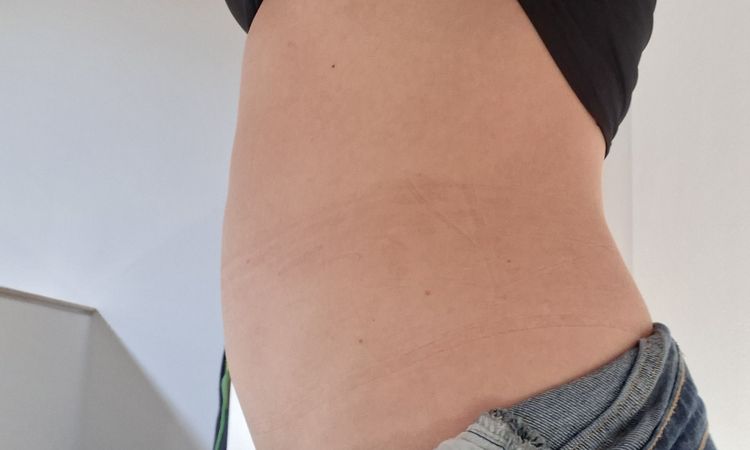 Renuvion su addome dopo liposuzione - 84001