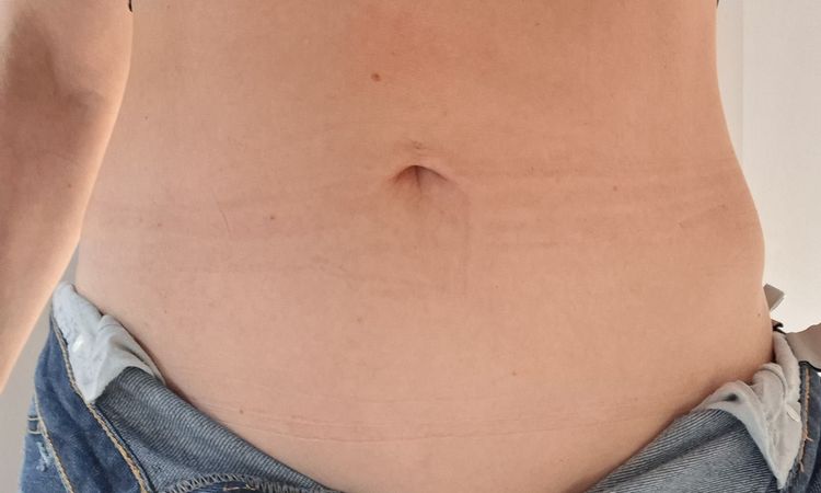Renuvion su addome dopo liposuzione - 84002