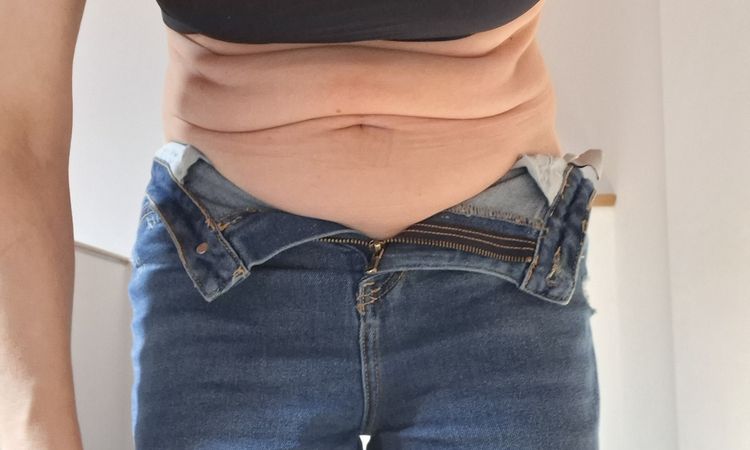Renuvion su addome dopo liposuzione - 84003