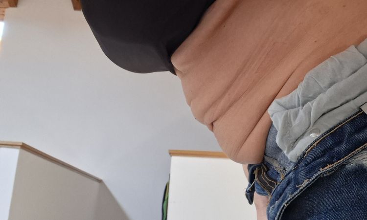 Renuvion su addome dopo liposuzione - 84004