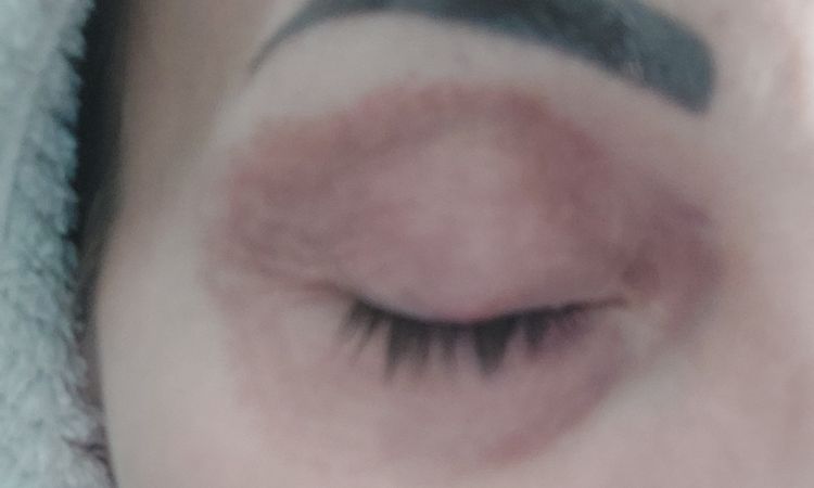 iperpigmentazione palpebra superiore e inferiore  post laser plex - 84005
