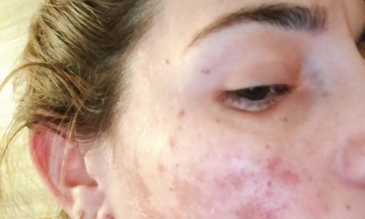 Croste post peeling acido glicolico - 84034