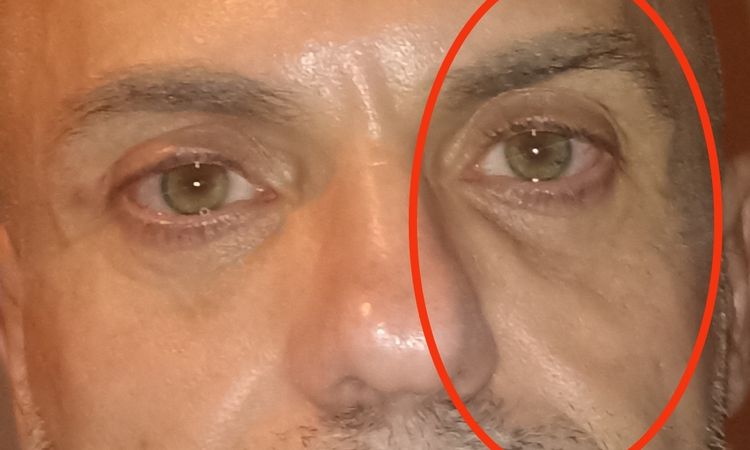 ialuronidasi nella zona perioculare dopo Redensity II - 84051