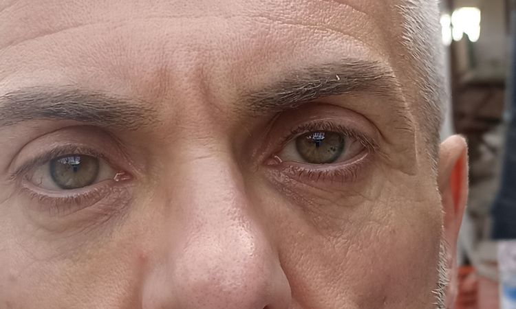 ialuronidasi nella zona perioculare dopo Redensity II - 84052