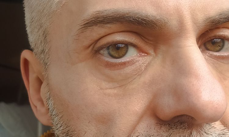 ialuronidasi nella zona perioculare dopo Redensity II - 84053