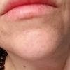 Rigonfiamento mento a distanza di mesi dal filler